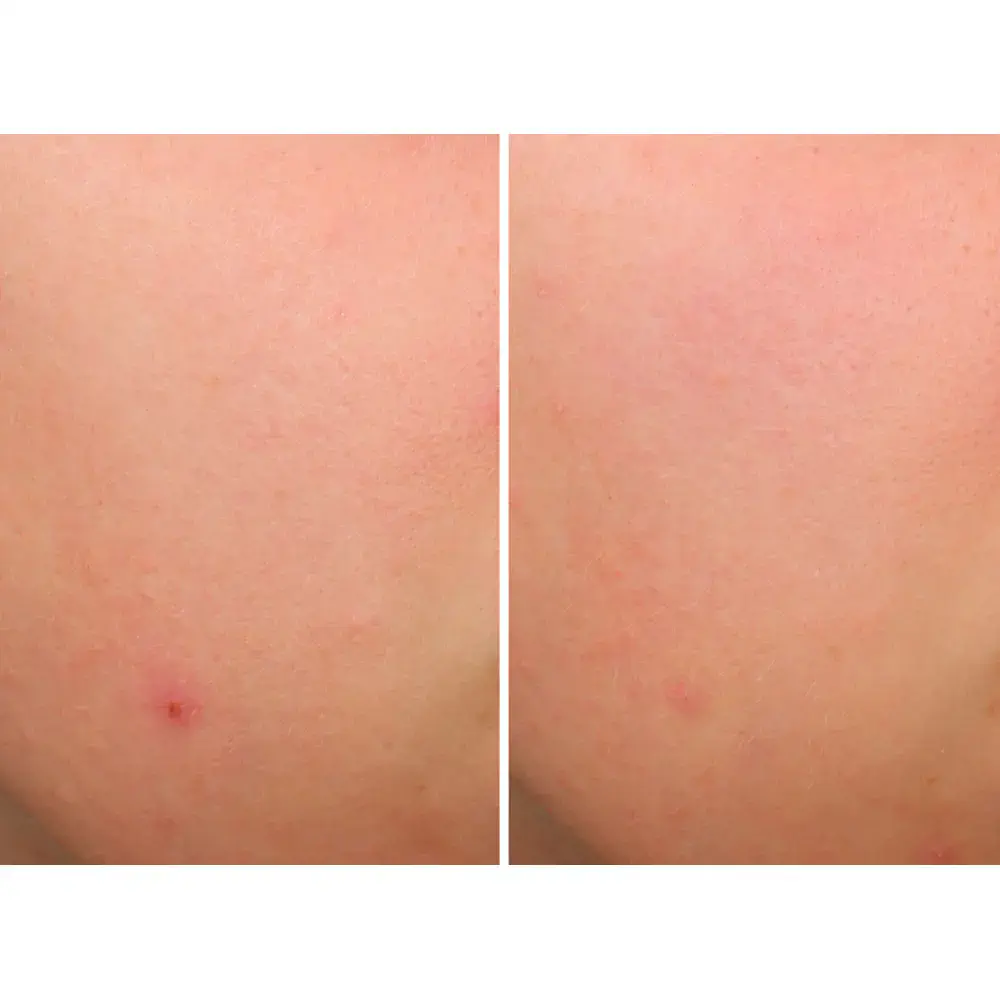 Bye Bye Brekout Serum by It Cosmetics Bye Bye Serums - Bye Bye Brekout Serum by It Cosmetics